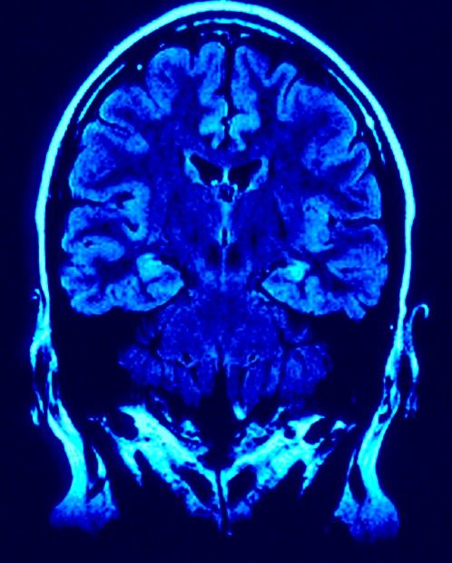 mri-image-brain.jpg