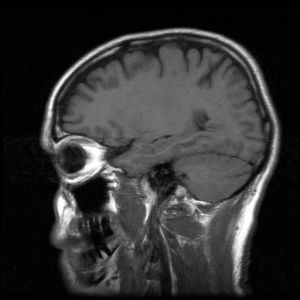 brain MRI